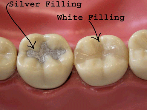 Dental Filling