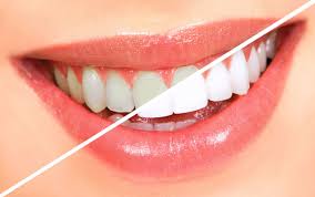 Teeth Whitening / Bleaching