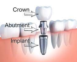 Dental implants
