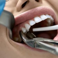 Dental Extractions