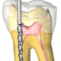 Root Canal Treatment